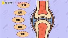 关节炎疼痛怎么治